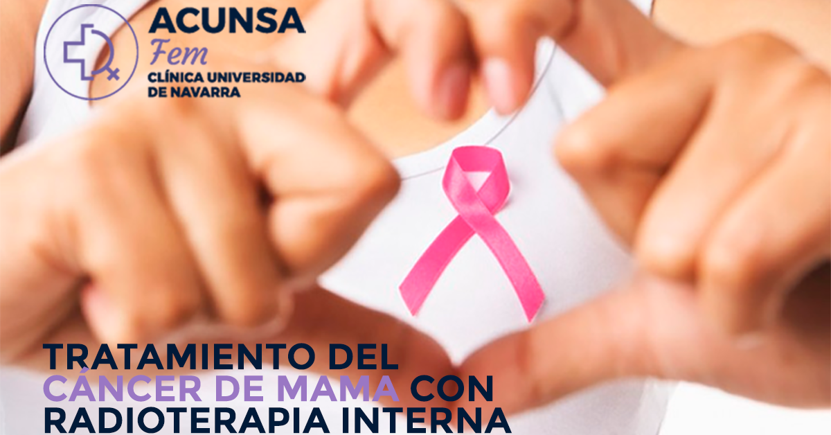 Radioterapia interna abordaje del cáncer de mama en sólo 5 días