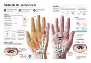 tunel-carpiano-acunsa-clinica-universidad-de-navarra-muñeca-mano-tratamiento-infografia